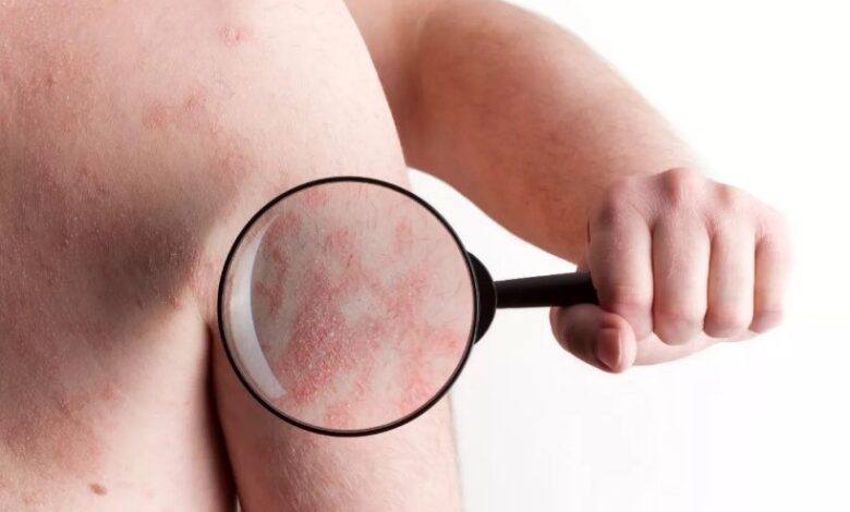 Dermatitis Atópica: Un desafío que comienza en la infancia de millones de personas y los afecta toda una vida