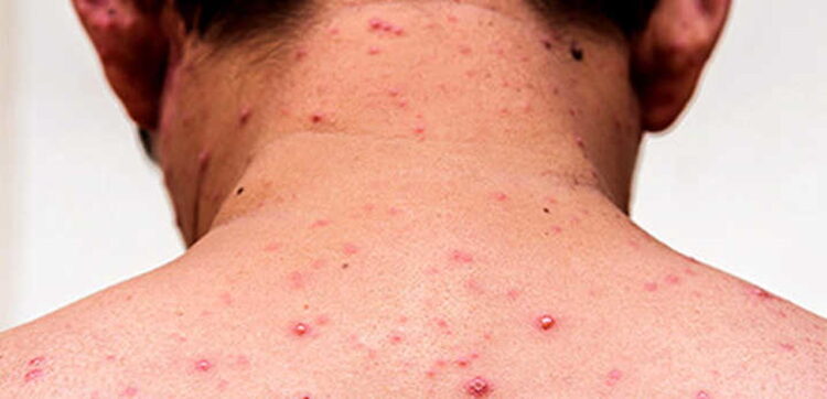 Salud pide a viajeros revisar sus vacunas por aumento de sarampión en América.