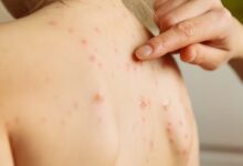 Caso importado de sarampión en menor activa vigilancia sanitaria